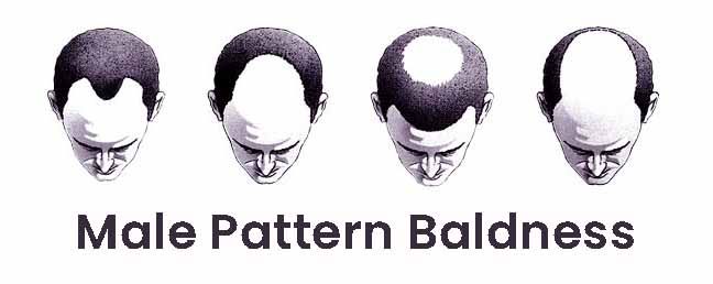 Male Pattern Baldness Causes Symptoms And Prevention The Wellness