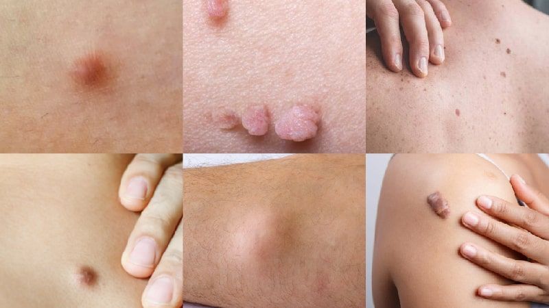 Do You Have a Lump Under Your Skin? It Might Be Lipoma - The Wellness Corner