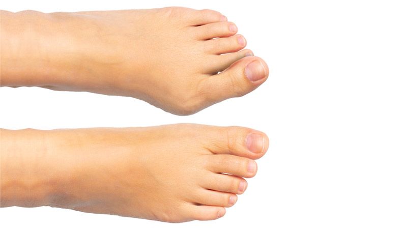 Types of Ankle Sprains, Symptoms and Treatments: Phoenician Foot