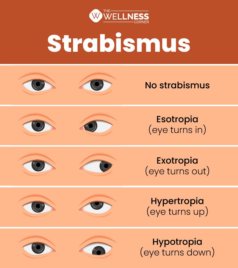 eyes-that-look-in-different-directions-from-each-other-strabismus